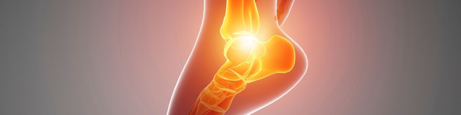 Espolón calcáneo y fascitis plantar