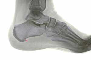 Espolon calcaneo y fascitis plantar 3