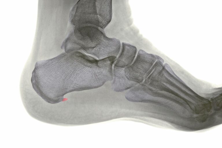 Espolon calcaneo y fascitis plantar 3