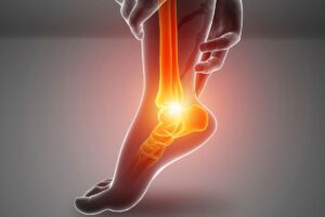 Espolon calcaneo y fascitis plantar 5