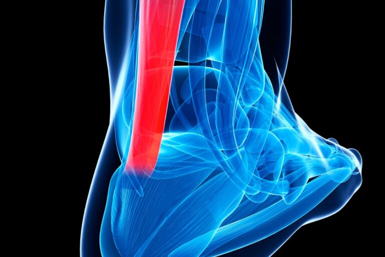 Tendinitis en el pie